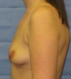 Breast Lift Before & After Image