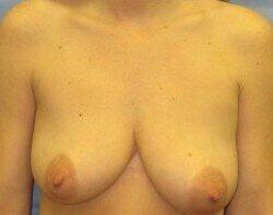 Breast Lift Before & After Image