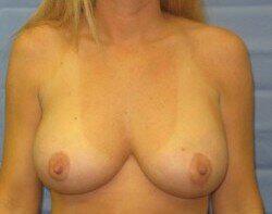 Breast Lift Before & After Image