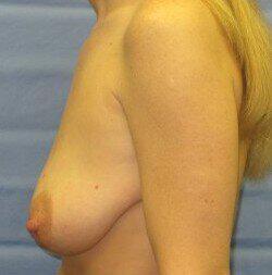 Breast Lift Before & After Image