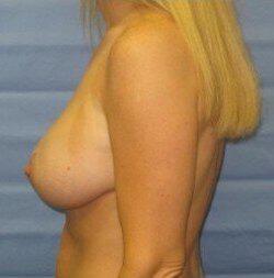 Breast Lift Before & After Image