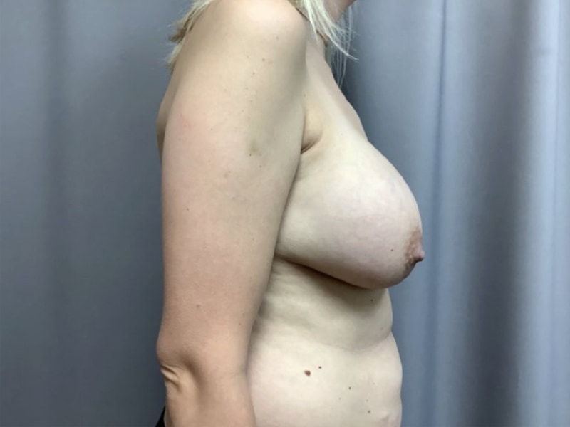 Implant Exchange with Lift Before & After Image