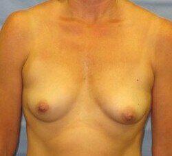 Saline Breast Augmentation Before & After Image