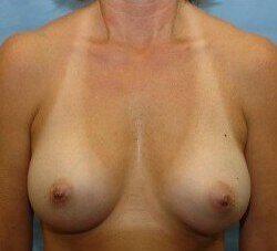 Saline Breast Augmentation Before & After Image