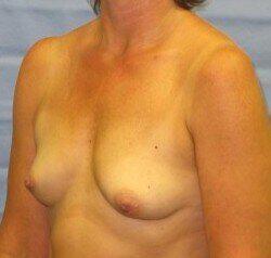 Saline Breast Augmentation Before & After Image