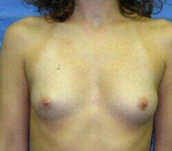 Saline Breast Augmentation Before & After Image