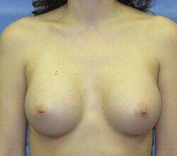 Saline Breast Augmentation Before & After Image