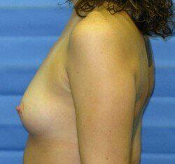 Saline Breast Augmentation Before & After Image