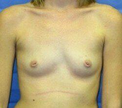 Saline Breast Augmentation Before & After Image