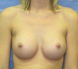 Saline Breast Augmentation Before & After Image