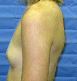 Saline Breast Augmentation Before & After Image