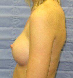 Saline Breast Augmentation Before & After Image