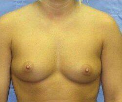 Saline Breast Augmentation Before & After Image