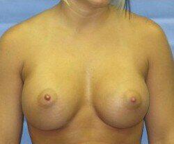 Saline Breast Augmentation Before & After Image