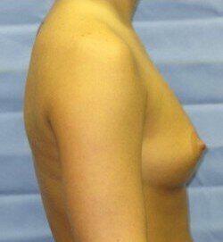Saline Breast Augmentation Before & After Image