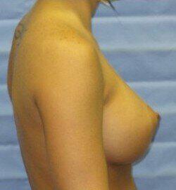 Saline Breast Augmentation Before & After Image