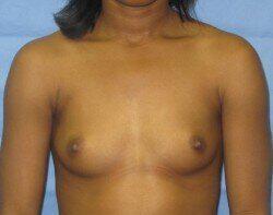 Silicone Breast Augmentation Before & After Image