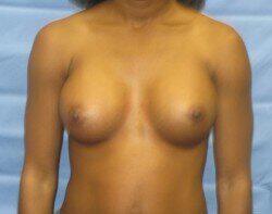 Silicone Breast Augmentation Before & After Image