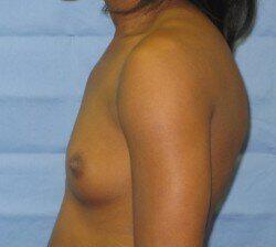 Silicone Breast Augmentation Before & After Image