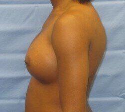 Silicone Breast Augmentation Before & After Image