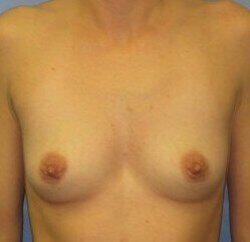 Silicone Breast Augmentation Before & After Image