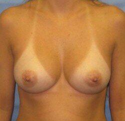 Silicone Breast Augmentation Before & After Image