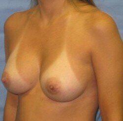 Silicone Breast Augmentation Before & After Image