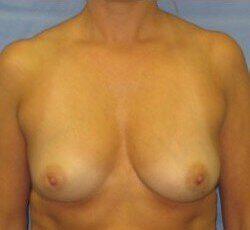 Silicone Breast Augmentation Before & After Image