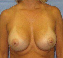 Silicone Breast Augmentation Before & After Image