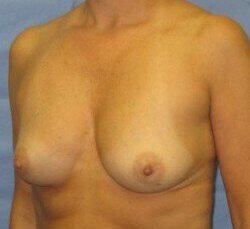 Silicone Breast Augmentation Before & After Image