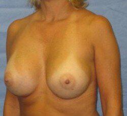 Silicone Breast Augmentation Before & After Image