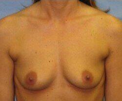 Silicone Breast Augmentation Before & After Image