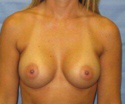 Silicone Breast Augmentation Before & After Image