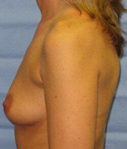 Silicone Breast Augmentation Before & After Image