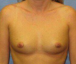 Silicone Breast Augmentation Before & After Image