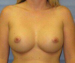 Silicone Breast Augmentation Before & After Image