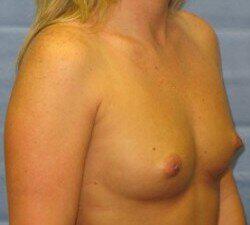 Silicone Breast Augmentation Before & After Image