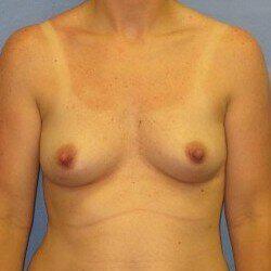 Silicone Breast Augmentation Before & After Image