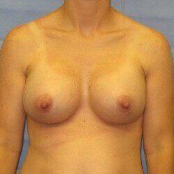 Silicone Breast Augmentation Before & After Image