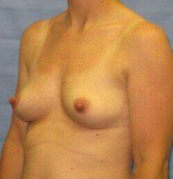 Silicone Breast Augmentation Before & After Image