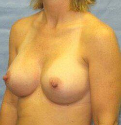 Silicone Breast Augmentation Before & After Image