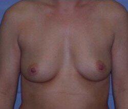 Silicone Breast Augmentation Before & After Image