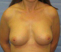 Silicone Breast Augmentation Before & After Image