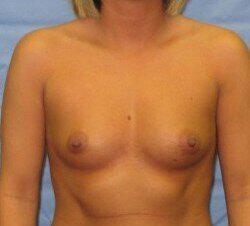 Silicone Breast Augmentation Before & After Image