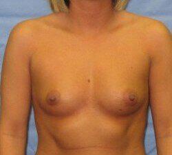 Silicone Breast Augmentation Before & After Image
