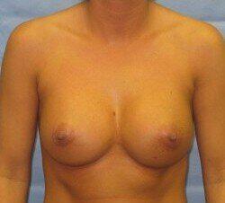 Silicone Breast Augmentation Before & After Image