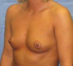 Silicone Breast Augmentation Before & After Image