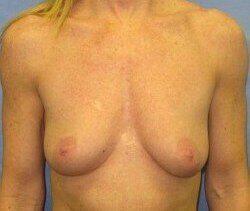 Silicone Breast Augmentation Before & After Image