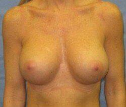 Silicone Breast Augmentation Before & After Image