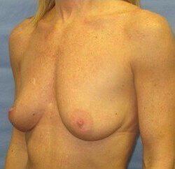 Silicone Breast Augmentation Before & After Image